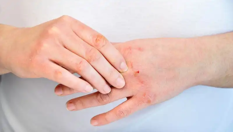 Yetersiz Protein Alımının Belirtileri: 6 İşaretle Sağlığınıza Dikkat Edin